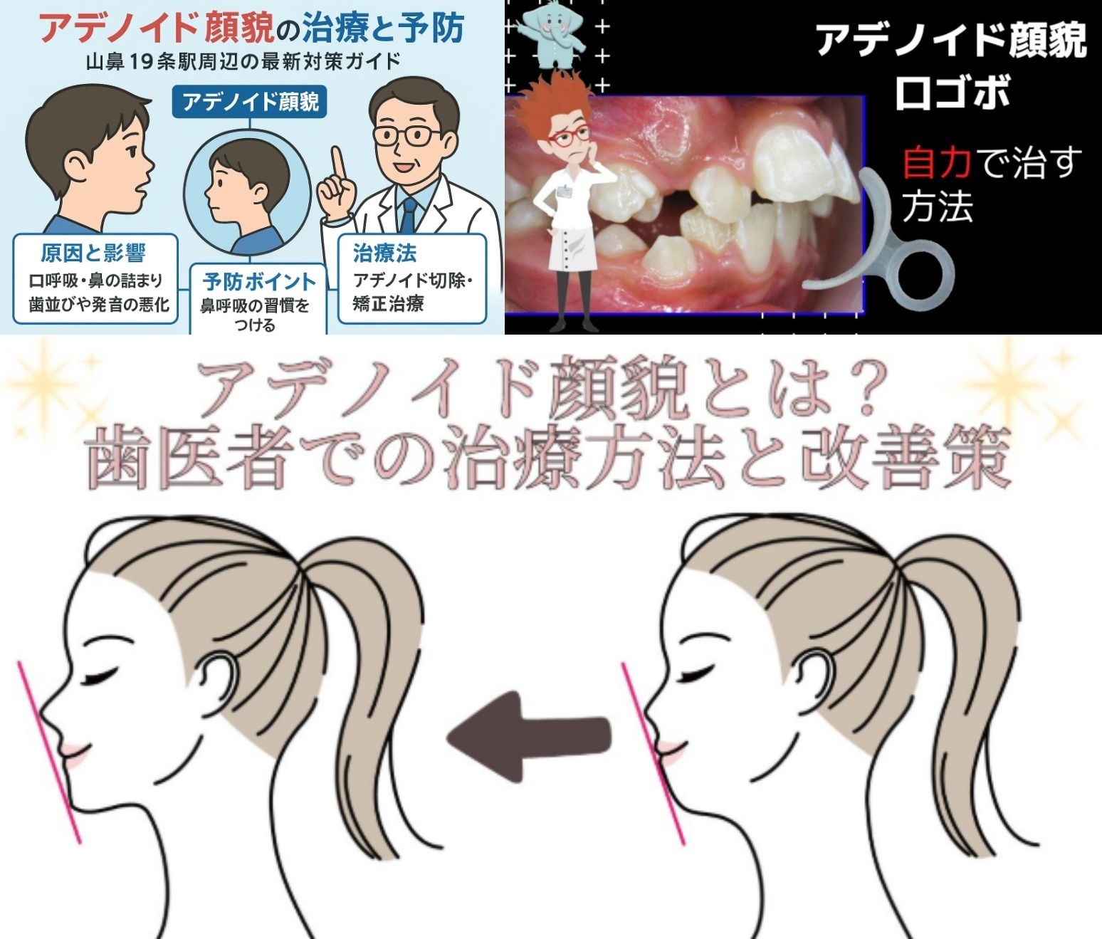 3. アデノイド顔貌の治療法と改善方法.jpg