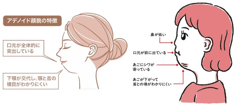 2. アデノイド顔貌の特徴と原因.jpg