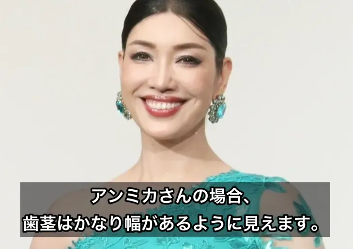 アンミカ ガミースマイル
