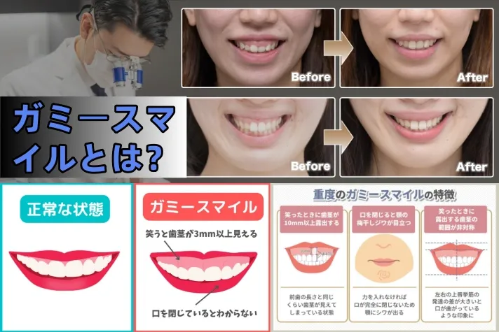 1. ガミースマイルとは？特徴と一般的なイメージ (2).webp